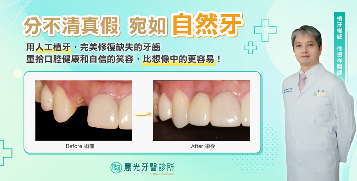 分不清真假 前牙植牙